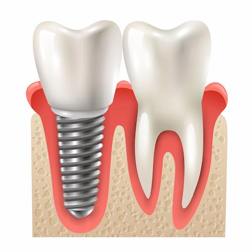dental-implant-img