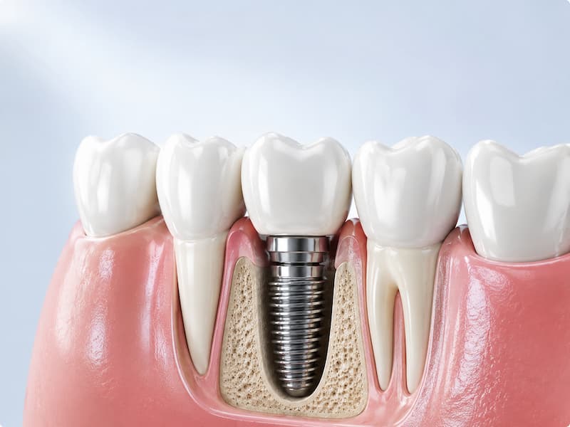 dental-implant-suman-dental-health-care