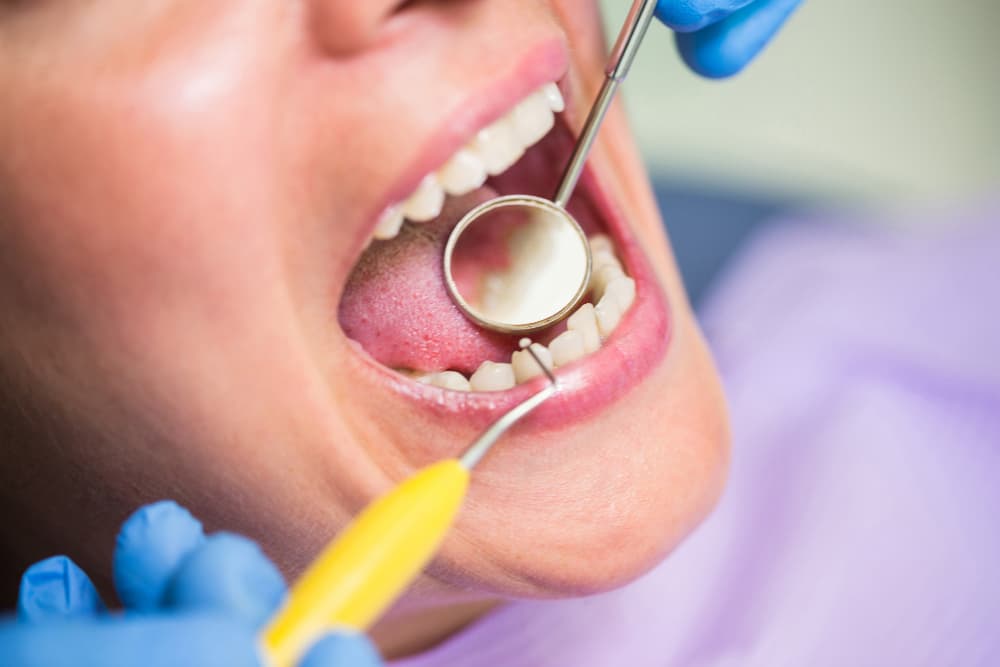 A Permanent Solution for DecayedFractured Teeth - Dental Fillings in Aliganj, Lucknow